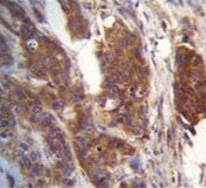 IHC testing of FFPE human bladder carcinoma tissue with Ufm1-conjugating enzyme 1 antibody. HIER: st