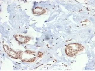 IHC staining of FFPE human breast carcinoma tissue with SOX4 antibody (clone PCRP-SOX4-1D6). HIER: b