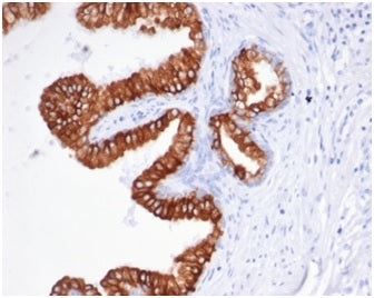 IHC staining of FFPE human prostate carcinoma tissue with recombinant EpCAM antibody (clone rEGP40/8