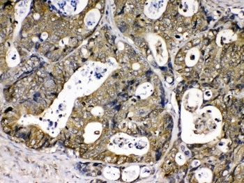 IHC testing of FFPE human intestinal cancer tissue with Cyclophilin A antibody at 1ug/ml. Required H