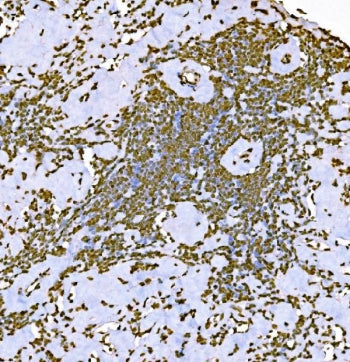 IHC staining of FFPE Hodgkin's lymphoma tissue with H1F0 antibody. HIER: boil tissue sections in pH8
