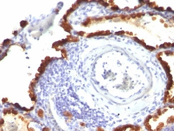 IHC: Formalin-fixed, paraffin-embedded human lung carcinoma stained with Keratin 7 antibody (KRT7/76