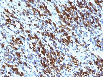 IHC: Formalin-fixed, paraffin-embedded human Rhabdomyosarcoma stained with Myogenin antibody cocktai
