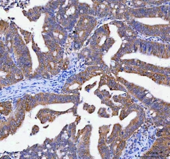 IHC staining of FFPE human rectum adenocarcinoma tissue with Lysophospholipase 1 antibody. HIER: boi
