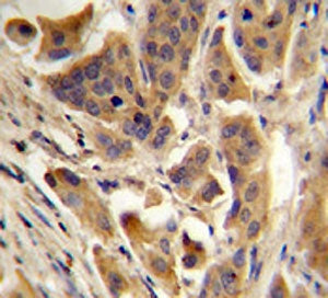 IHC testing of FFPE human bladder carcinoma with RBCK1 antibody. HIER: steam section in pH6 citrate 