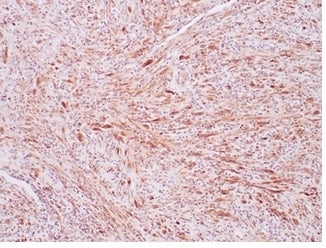 IHC staining of FFPE human inflammatory myofibroblastic tumor with recombinant ALK antibody (clone A