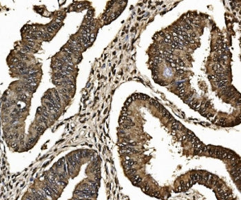 IHC staining of FFPE human ovarian serous adenocarcinoma tissue with Proteasome 20S beta 7 antibody.