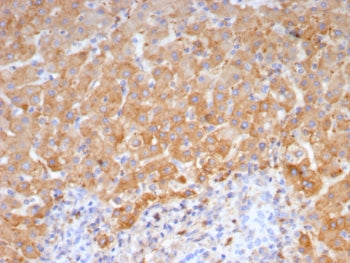 IHC staining of FFPE human hepatocellular carcinoma tissue with Haptoglobin antibody (clone HP/4815)