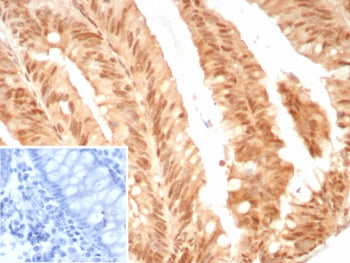 IHC staining of FFPE human colon cancer tissue with E2F4 antibody (clone E2F4/8811R). Inset: PBS use