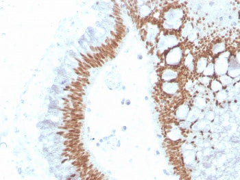 IHC staining of FFPE human colon carcinoma with recombinant SATB2 antibody (clone SATB2/4374R). HIER