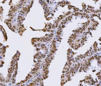 IHC staining of FFPE human ovarian cancer tissue with PSF antibody. HIER: boil tissue sections in pH