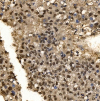 IHC staining of FFPE human liver cancer tissue with CPSF6 antibody. HIER: boil tissue sections in pH