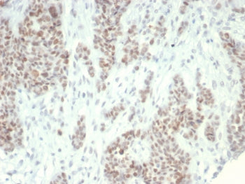 IHC staining of FFPE human ovarian carcinoma tissue with Lysine-Specific Demethylase 1 antibody (clo
