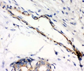 IHC testing of FFPE human breast cancer with Caldesmon antibody (clone CD-7). HIER: steamed with pH6 citrate buffer.