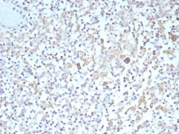 IHC staining of FFPE human Hodgkins lymphoma tissue with recombinant Bcl-X antibody (clone BCL2L1/92
