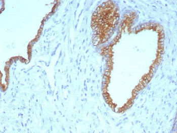 IHC staining of FFPE human prostate carcinoma tissue with CK5/6 antibody (clone KRT5.6/9104). HIER: 