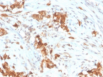 IHC staining of FFPE human mesothelioma with Mesothelin antibody (clone MSLN/3385). HIER: boil tissu