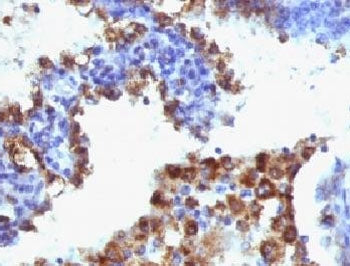IHC: Formalin-fixed, paraffin-embedded human lung adenocarcinoma stained with Napsin-A antibody (NAP