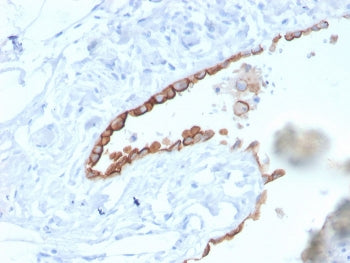 IHC staining of FFPE human lung mesothelioma with Mesothelin antibody (clone MSLN/3384). HIER: boil 