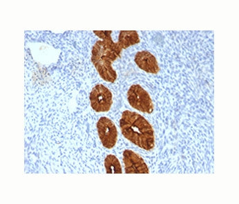 Epithelial Marker Antigen antibody IHC testing of formalin-paraffin human endometrial cancer tissue 