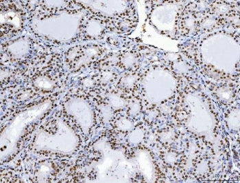 IHC staining of FFPE human thyroid cancer tissue with CHTOP antibody. HIER: boil tissue sections in 