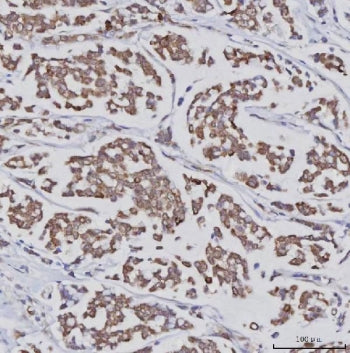 IHC staining of FFPE human breast cancer tissue with PLXDC2 antibody. HIER: boil tissue sections in 