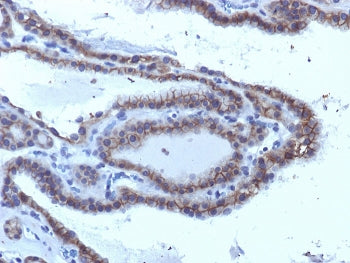 IHC testing of FFPE human thyroid carcinoma with TSHR antibody (clone SPM223). Required HIER: boil t