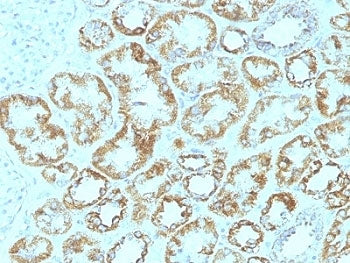 IHC: Formalin-fixed, paraffin-embedded human renal cell carcinoma stained with Laminin gamma 1 antib