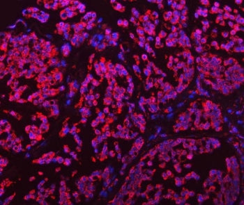 Immunofluorescent staining of FFPE human breast cancer tissue with GLUD1/2 antibody (red) and DAPI n