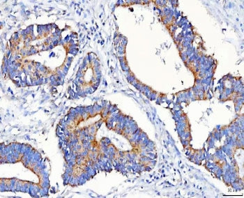 IHC staining of FFPE human colorectal adenocarcinoma tissue with METAP1D antibody. HIER: boil tissue