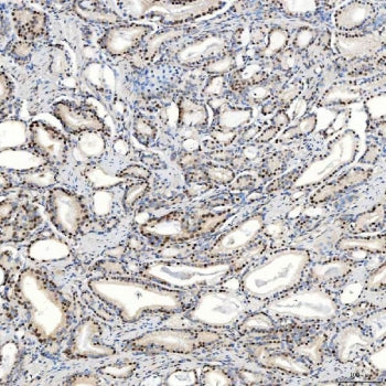 IHC staining of FFPE human prostate adenocarcinoma tissue with U1 snRNP C antibody. HIER: boil tissu