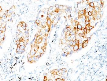 IHC staining of FFPE human lung small cell carcinoma with Cytokeratin 7/17 antibody (clone C-46). HI