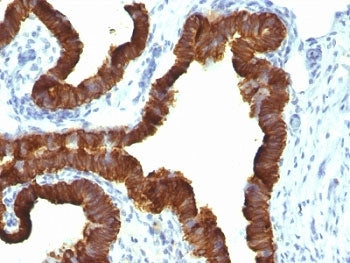 IHC: Formalin-fixed, paraffin-embedded human ovarian carcinoma stained with Keratin 7 antibody (KRT7