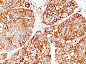 Melanoma Marker Antibody Cocktail (MART-1 &amp; Tyrosinase &amp; gp100)