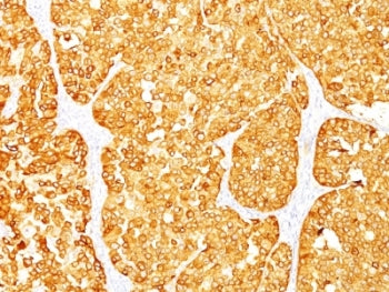 IHC: Formalin-fixed, paraffin-embedded human melanoma stained with MART-1 / Melan-A antibody (M2-7C1