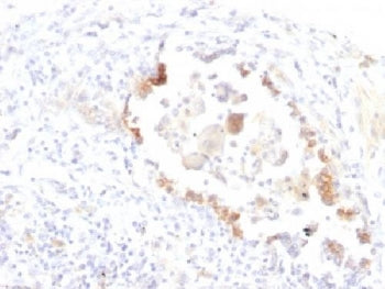 IHC testing of FFPE human lung carcinoma with Lewis y antibody (clone LWY/1463). Required HIER: boil