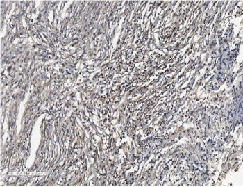 IHC staining of FFPE human meningoma tissue with SHANK3 antibody. HIER: boil tissue sections in pH8 