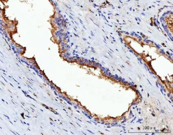 IHC staining of FFPE human prostate cancer tissue with VIPR2 antibody. HIER: boil tissue sections in