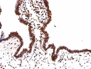 IHC: Formalin-fixed, paraffin-embedded human ovarian carcinoma stained with Histone H1 antibody (clo
