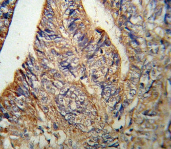 IHC testing of FFPE human colon carcinoma tissue with IL1RN antibody. HIER: steam section in pH6 cit