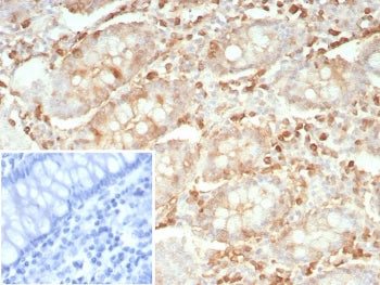 IHC staining of FFPE human colon carcinoma tissue with recombinant STMN1 antibody (clone rSTMN1/9255
