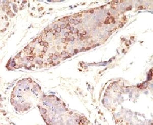 IHC testing of FFPE human testicular carcinoma with MAGE-1 antibody (clone MZ2E/838). Staining of fo