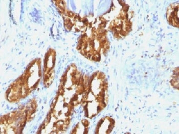IHC testing of human prostate carcinoma with PSAP antibody (clone ACPP/1338). Required HIER: boil ti