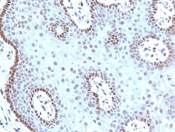 IHC: Formalin-fixed, paraffin-embedded human cervical carcinoma stained with c-Myc antibody (MYC909)