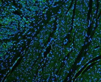 Immunofluorescent staining of FFPE human colon cancer with CD39 antibody (green) and DAPI nuclear st