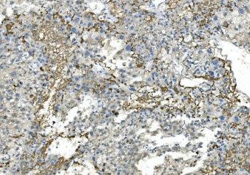 IHC staining of FFPE human liver cancer with FGB antibody. HIER: boil tissue sections in pH8 EDTA fo