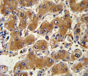IHC testing of FFPE human hepatocarcinoma tissue with COL6A1 antibody. HIER: steam section in pH6 ci