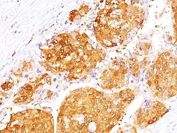 IHC: Formalin-fixed, paraffin-embedded human hepatocellular carcinoma stained with Arginase 1 antibo
