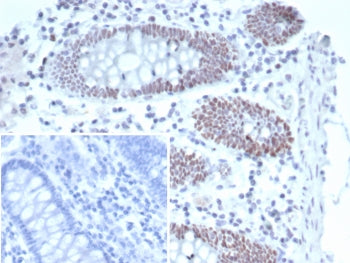 IHC staining of FFPE human colon carcinoma tissue with TBX21 antibody (clone TBX21/6724). Inset: PBS
