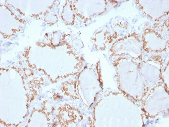 IHC staining of FFPE human thyroid carcinoma with Thyroid Peroxidase antibody. HIER: boil tissue sec